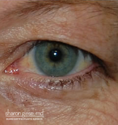 eye lift before picture